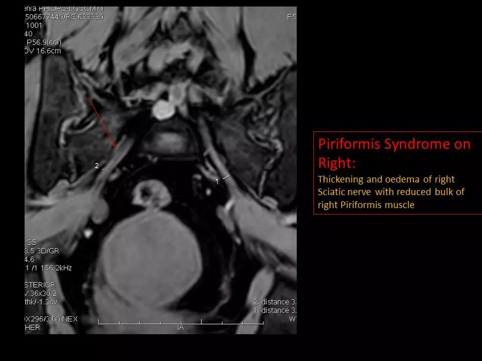 图文详解梨状肌综合征MR表现及诊治技巧，值得推荐！