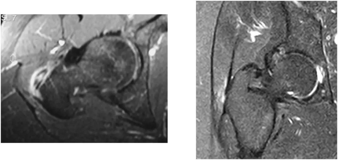 图文详解梨状肌综合征MR表现及诊治技巧，值得推荐！