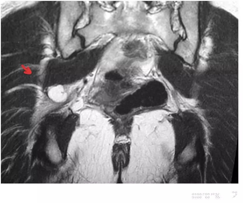 图文详解梨状肌综合征MR表现及诊治技巧，值得推荐！