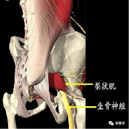 图文详解梨状肌综合征MR表现及诊治技巧，值得推荐！