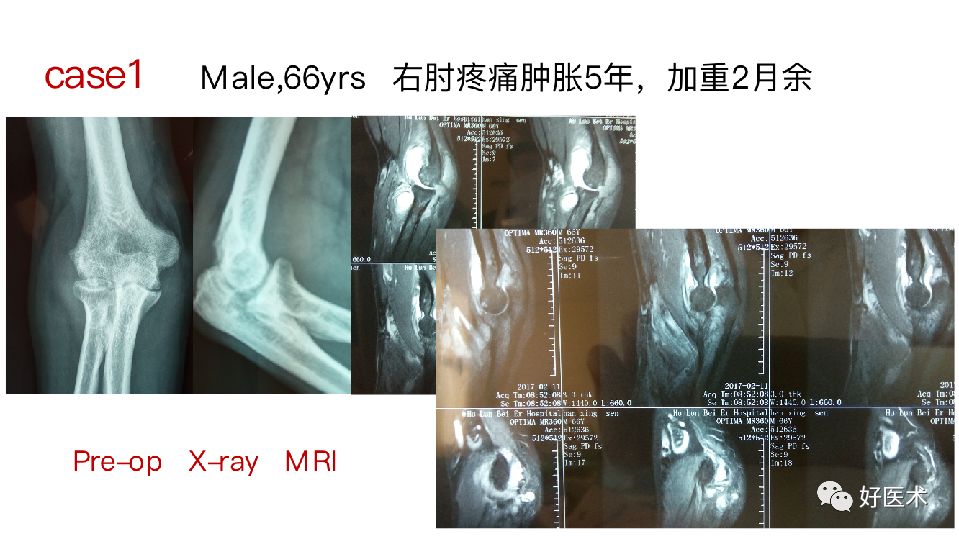 肘关节僵硬的个体化治疗选择，你弄懂了吗？