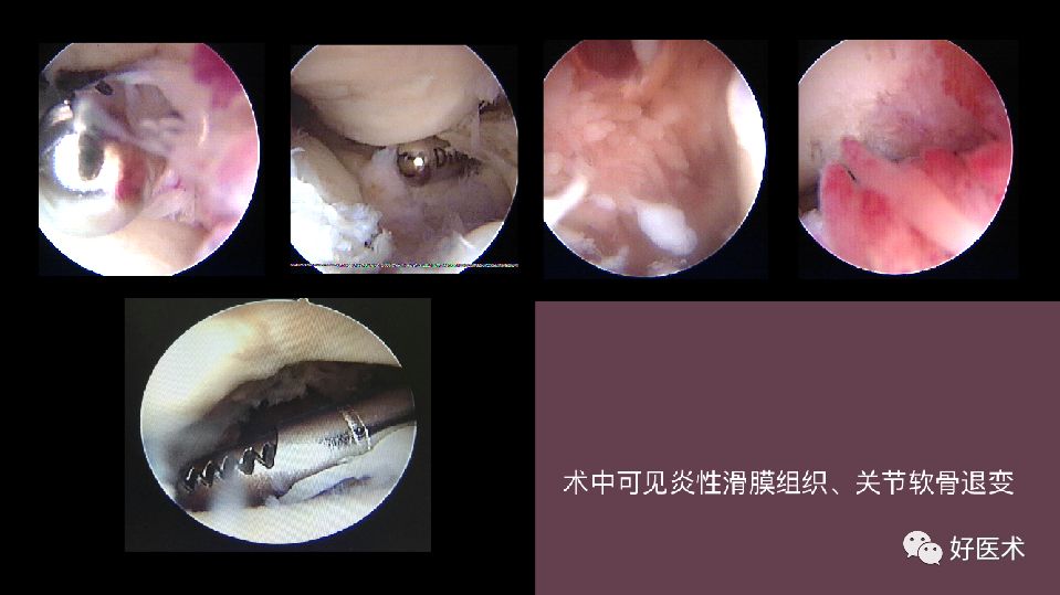 肘关节僵硬的个体化治疗选择，你弄懂了吗？