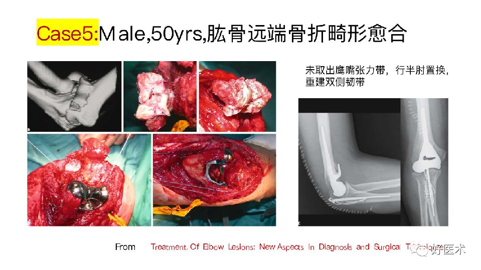 肘关节僵硬的个体化治疗选择，你弄懂了吗？