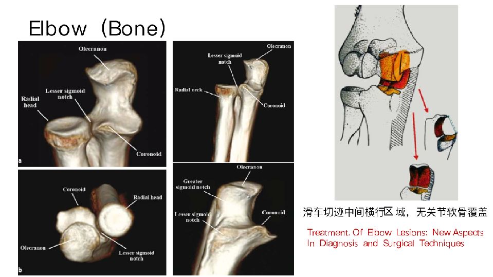 肘关节僵硬的个体化治疗选择，你弄懂了吗？