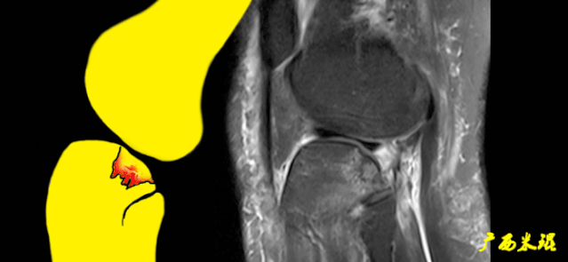 一文读懂前交叉韧带损伤的MRI诊断！