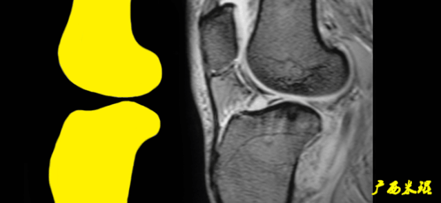 一文读懂前交叉韧带损伤的MRI诊断！