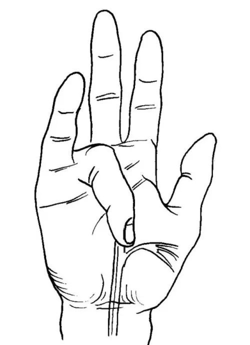 手指麻木就是颈椎病？警惕腕管综合征！