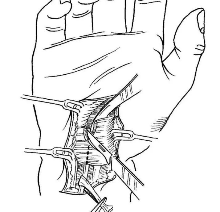 手指麻木就是颈椎病？警惕腕管综合征！