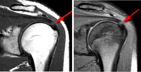 肩袖损伤的MRI诊断四大要点，千万别错过！