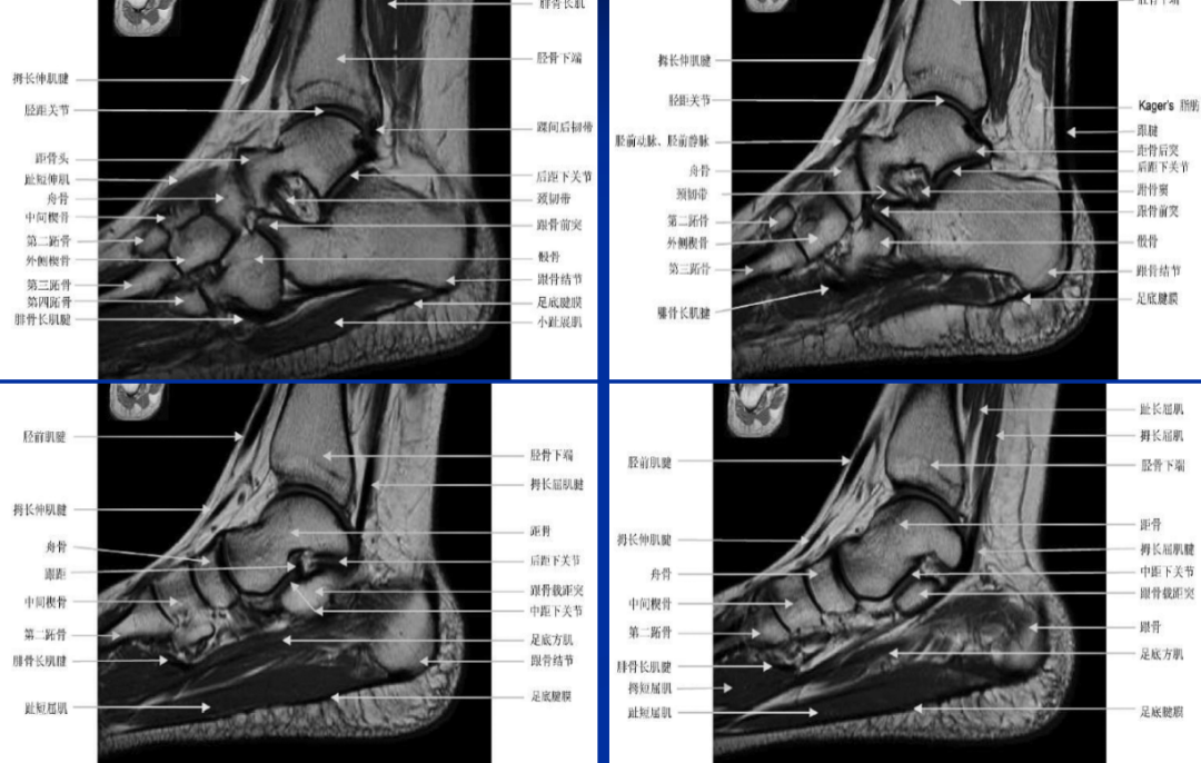 跗骨窦综合征影像表现及诊治技巧，基础提升必备！