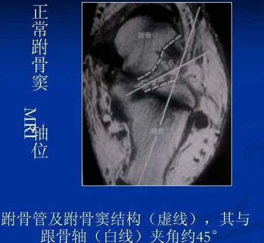 跗骨窦综合征影像表现及诊治技巧，基础提升必备！