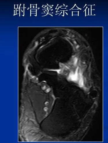 跗骨窦综合征影像表现及诊治技巧，基础提升必备！