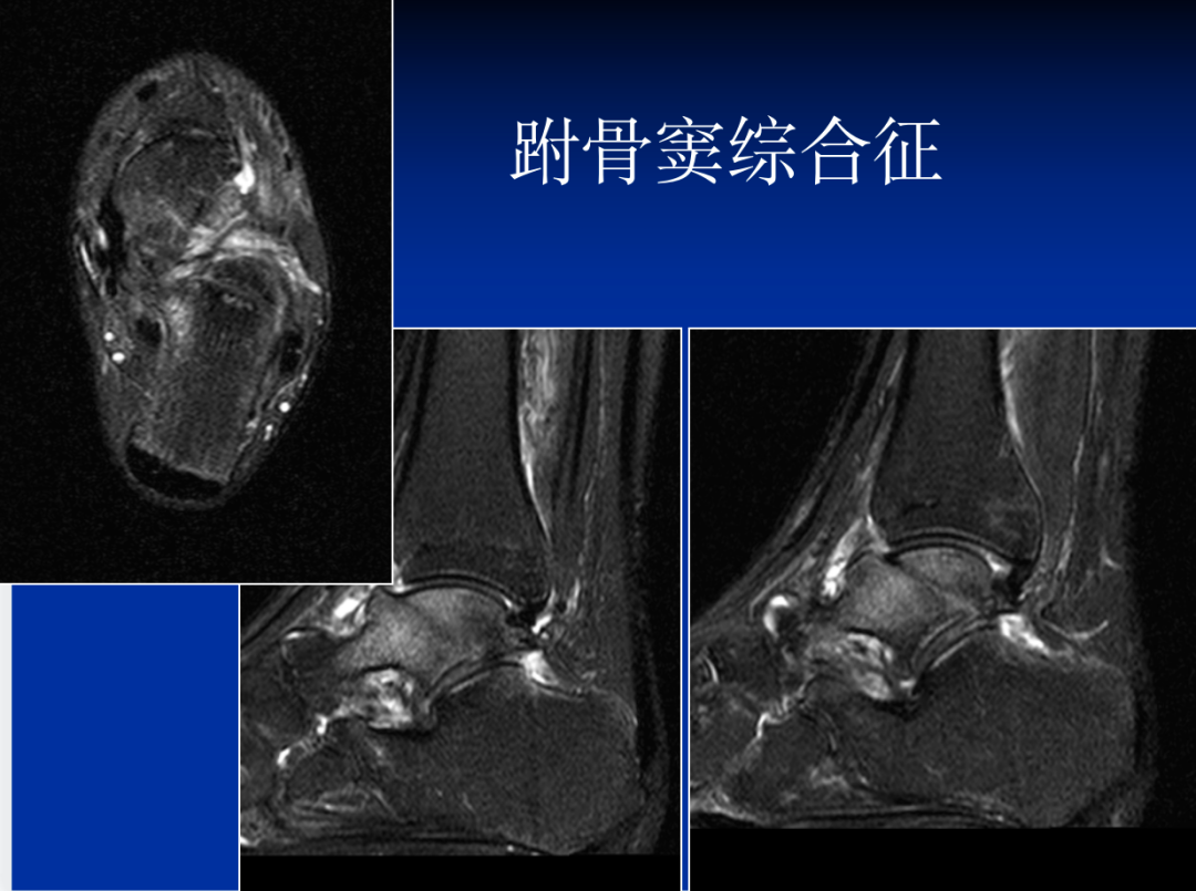 跗骨窦综合征影像表现及诊治技巧，基础提升必备！