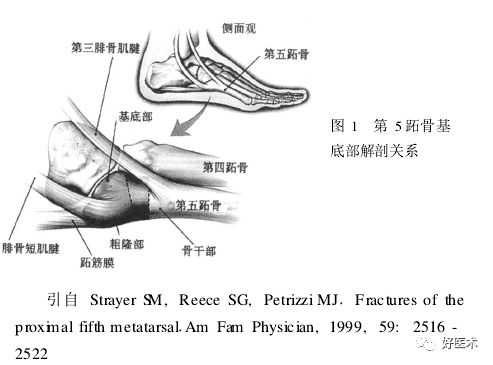 第五跖骨基底部骨折的分型和治疗，这些重点你都知道吗？