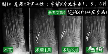 第五跖骨基底部骨折的分型和治疗，这些重点你都知道吗？