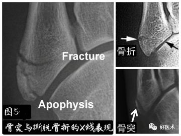 第五跖骨基底部骨折的分型和治疗，这些重点你都知道吗？