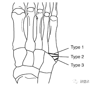 第五跖骨基底部骨折的分型和治疗，这些重点你都知道吗？