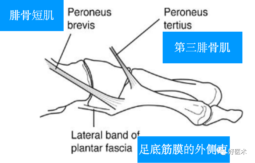 第五跖骨基底部骨折的分型和治疗，这些重点你都知道吗？