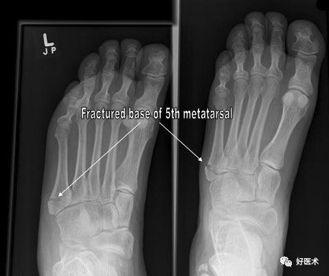 第五跖骨基底部骨折的分型和治疗，这些重点你都知道吗？