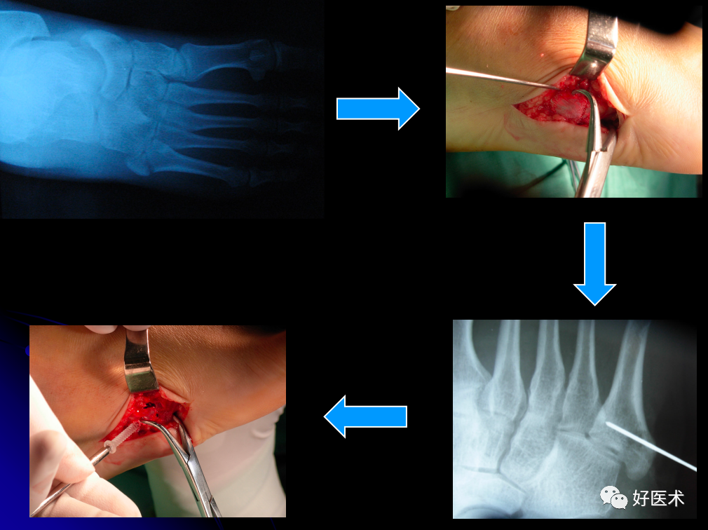 第五跖骨基底部骨折的分型和治疗，这些重点你都知道吗？