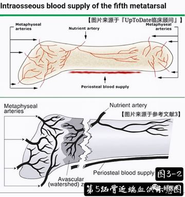 第五跖骨基底部骨折的分型和治疗，这些重点你都知道吗？