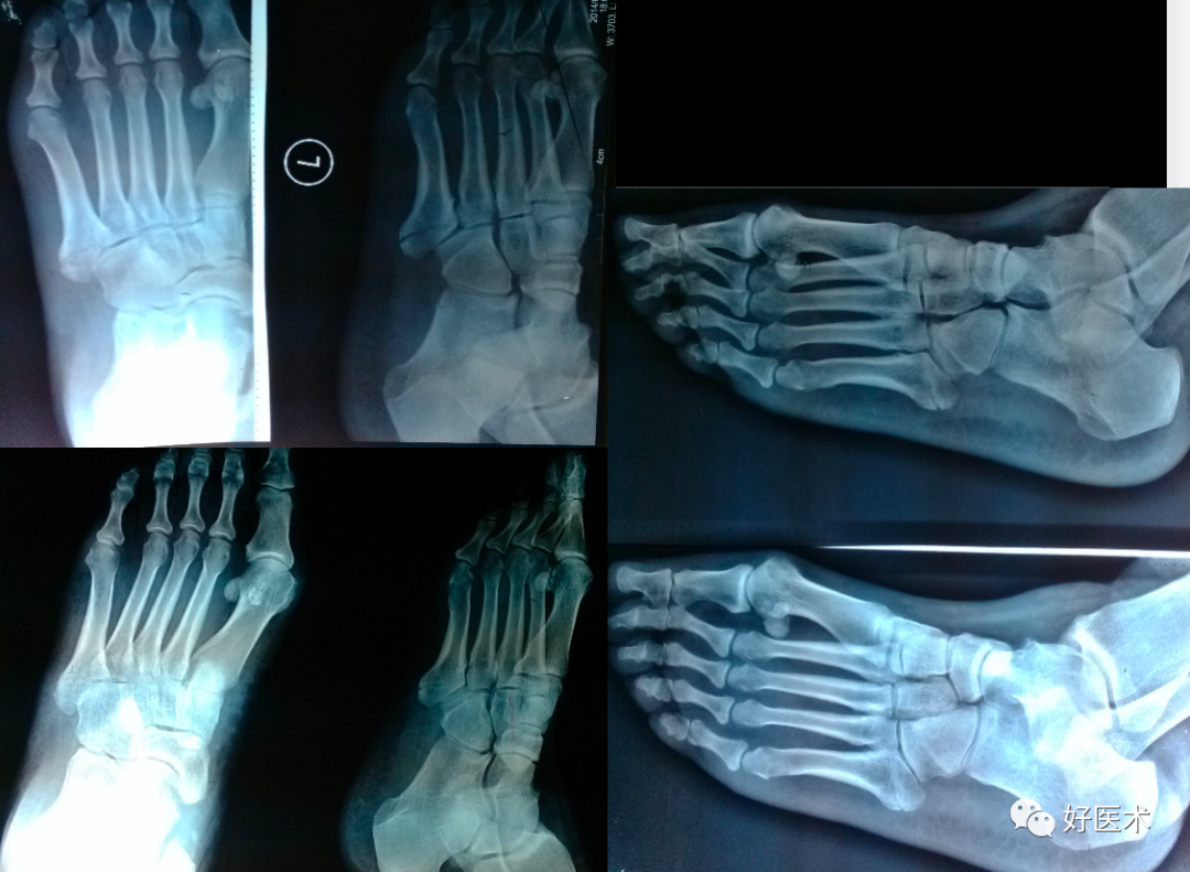 第五跖骨基底部骨折的分型和治疗，这些重点你都知道吗？