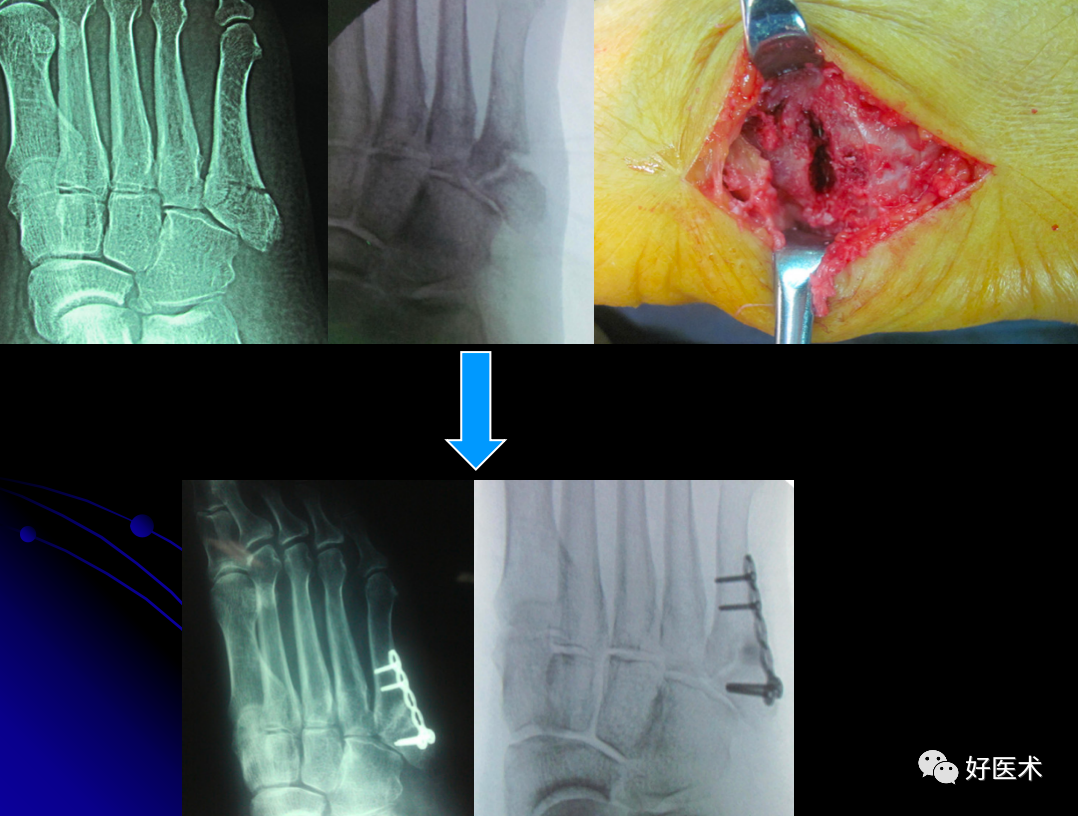 第五跖骨基底部骨折的分型和治疗，这些重点你都知道吗？