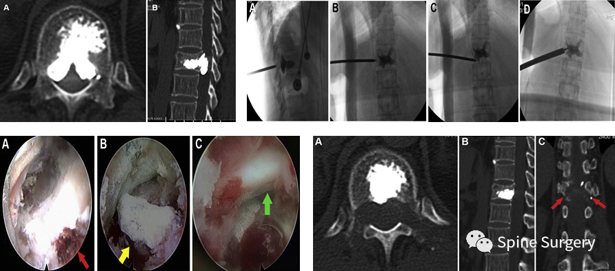 椎体成形术骨水泥渗漏相关问题，本文帮你解决！