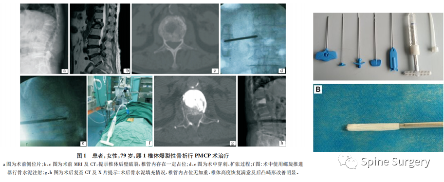 椎体成形术骨水泥渗漏相关问题，本文帮你解决！