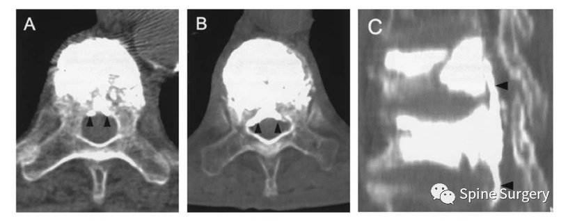 椎体成形术骨水泥渗漏相关问题，本文帮你解决！