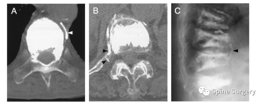 椎体成形术骨水泥渗漏相关问题，本文帮你解决！