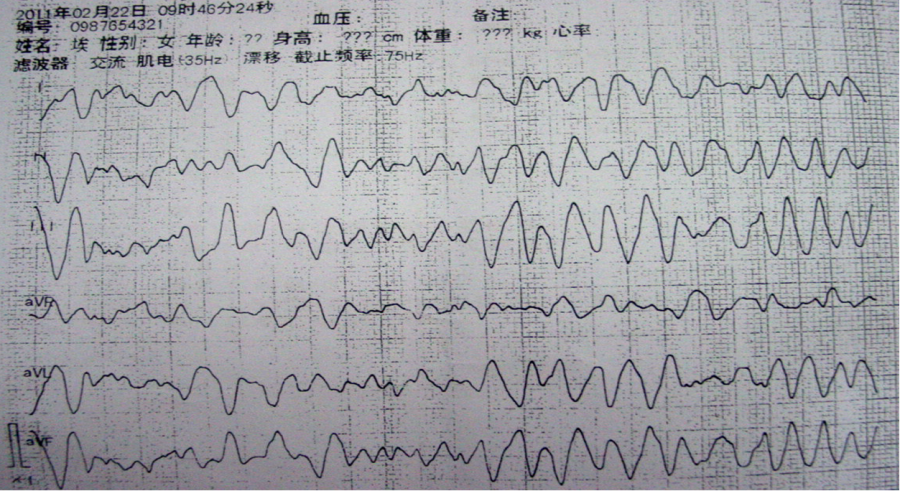 临床必备：心脏猝死预警心电图分析