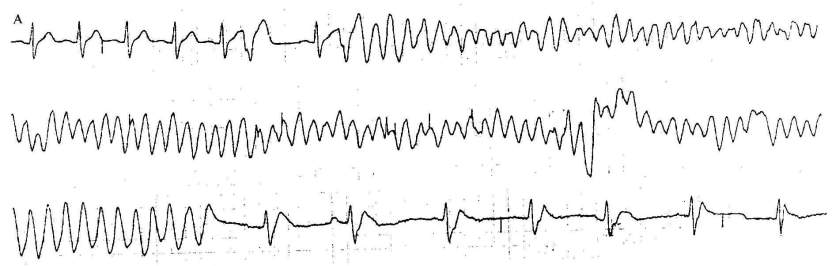 临床必备：心脏猝死预警心电图分析