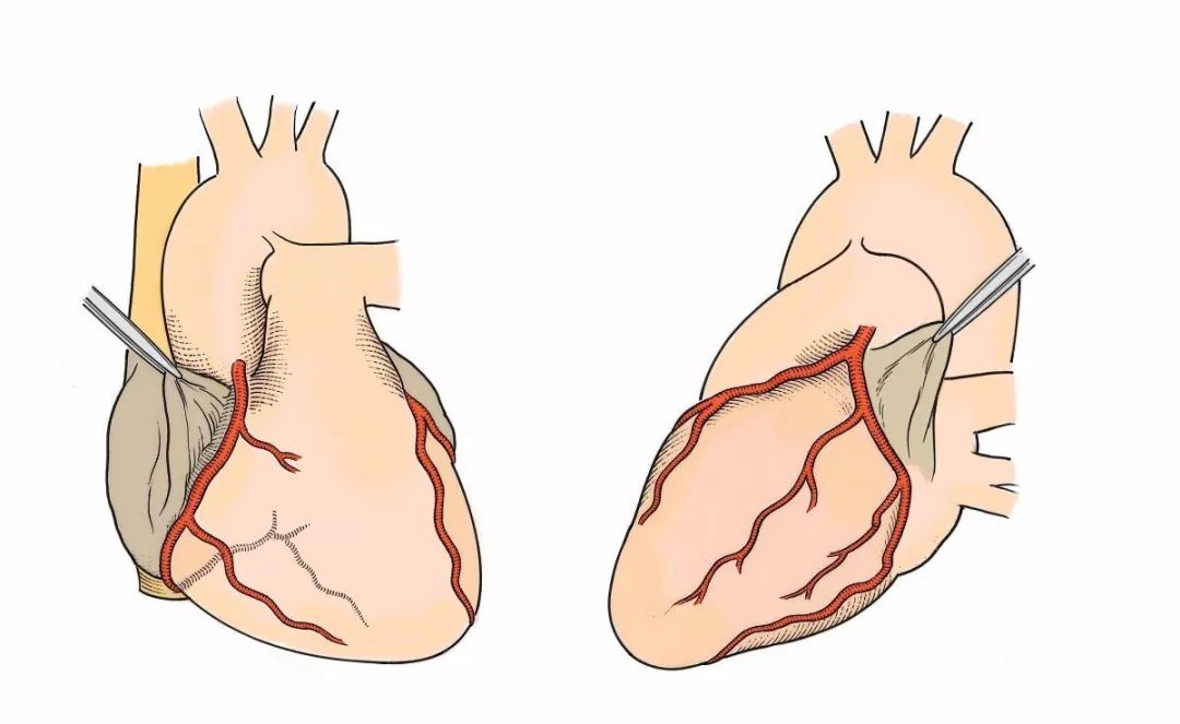 判断急性下壁心梗罪犯血管，两种体表心电图谁更优？