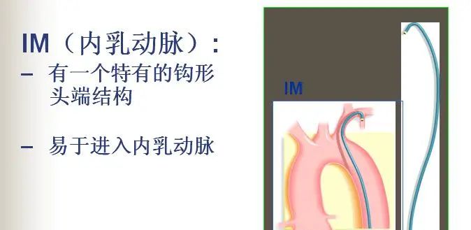 冠脉介入离不开的导管，你需要这篇文章！