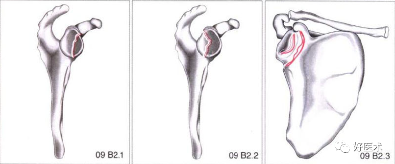 化繁为简，快速牢记上肢骨折常用分类与分型标准！