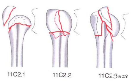 化繁为简，快速牢记上肢骨折常用分类与分型标准！