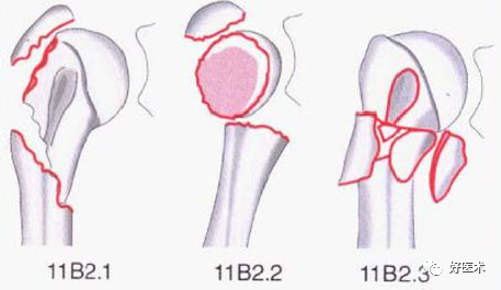 化繁为简，快速牢记上肢骨折常用分类与分型标准！