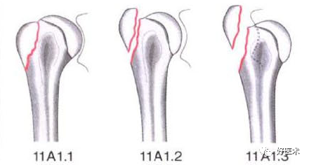化繁为简，快速牢记上肢骨折常用分类与分型标准！