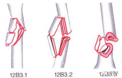 化繁为简，快速牢记上肢骨折常用分类与分型标准！