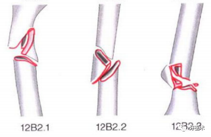 化繁为简，快速牢记上肢骨折常用分类与分型标准！