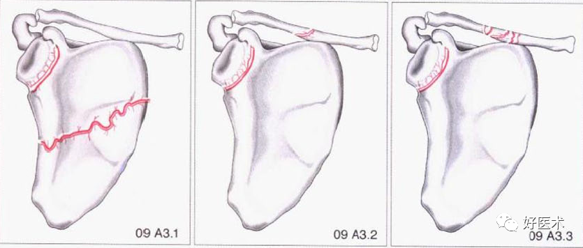 化繁为简，快速牢记上肢骨折常用分类与分型标准！