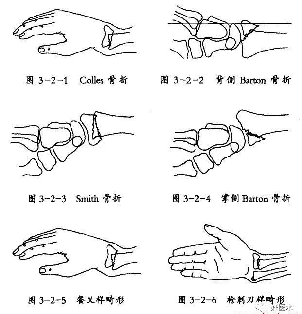 化繁为简，快速牢记上肢骨折常用分类与分型标准！
