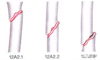 化繁为简，快速牢记上肢骨折常用分类与分型标准！