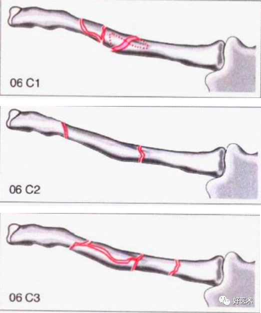 化繁为简，快速牢记上肢骨折常用分类与分型标准！