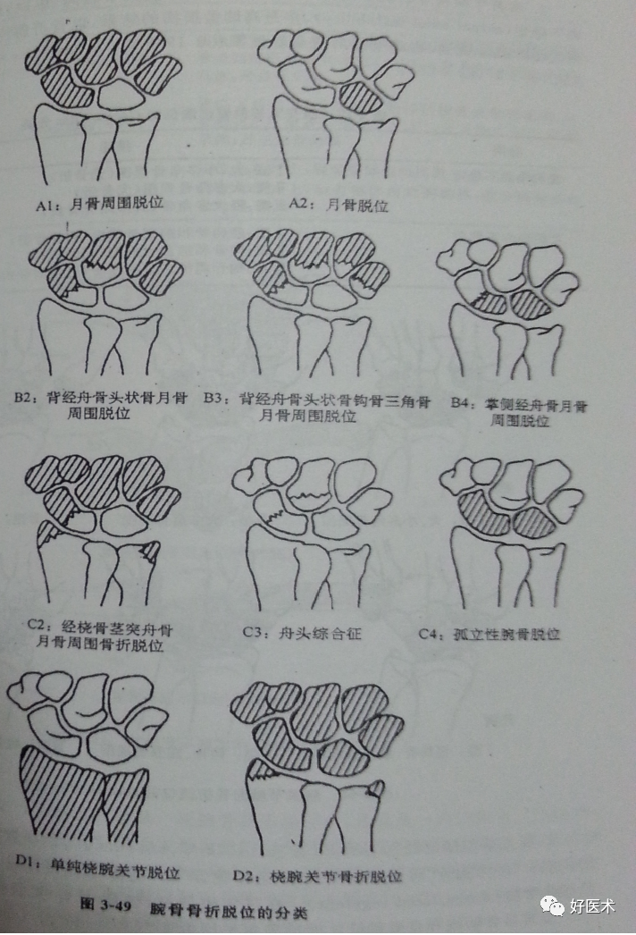 化繁为简，快速牢记上肢骨折常用分类与分型标准！