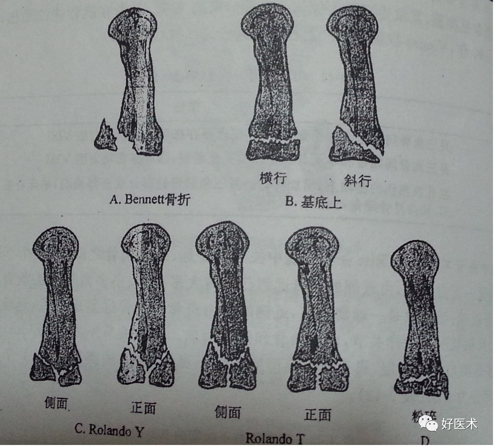 化繁为简，快速牢记上肢骨折常用分类与分型标准！