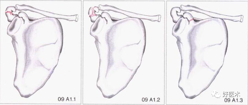 化繁为简，快速牢记上肢骨折常用分类与分型标准！