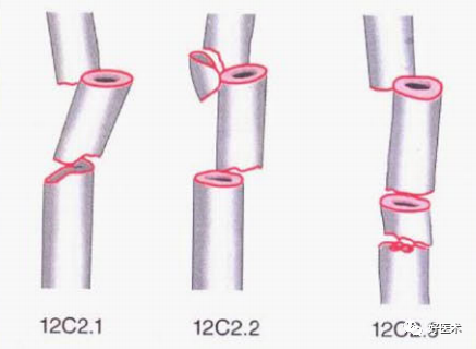 化繁为简，快速牢记上肢骨折常用分类与分型标准！