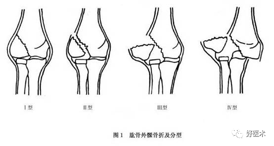 化繁为简，快速牢记上肢骨折常用分类与分型标准！